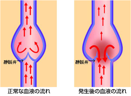 下肢静脈瘤のメカニズム