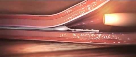 グルー（生体に安全な接着剤）による血管内塞栓術